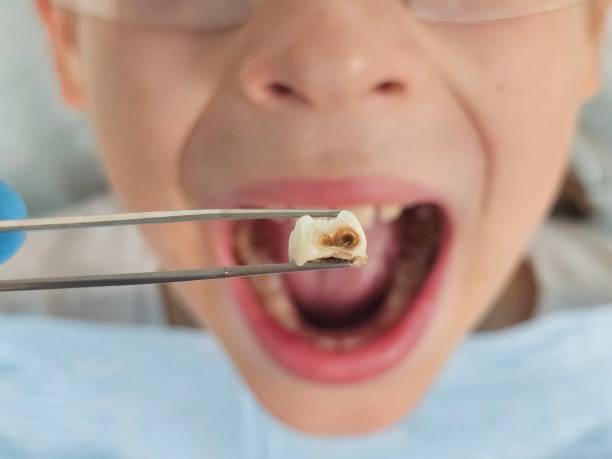 Best Emergency Root Canal Treatment in Cottonport, LA