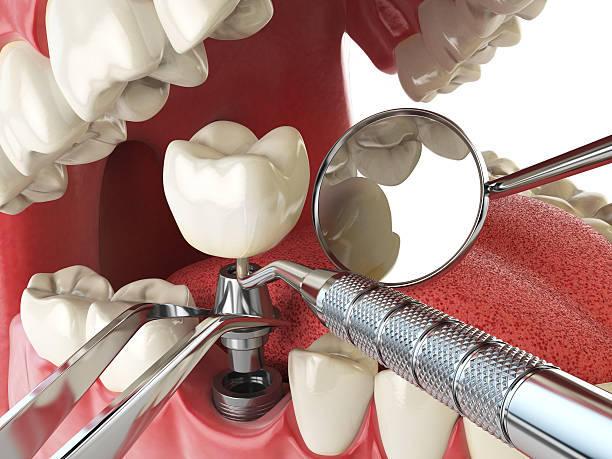 Best Emergency Broken Tooth Repair in Cottonport, LA